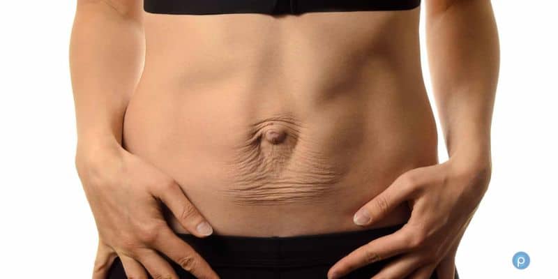 Diastasis Recti Explained: Causes, Symptoms & How to Heal Abdominal Separation