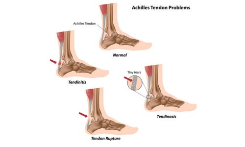 Achilles Tendon Injuries: Common Types, Causes & Recovery Tips